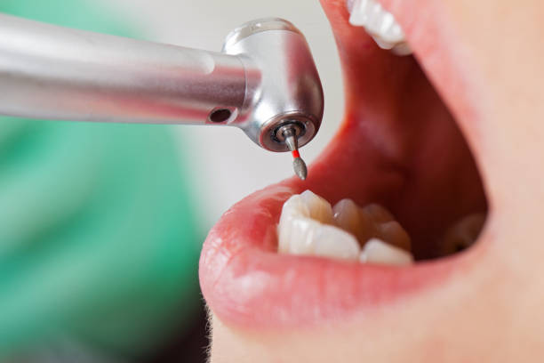 Best Broken or Cracked Tooth Emergency Dentist in Kana, UT